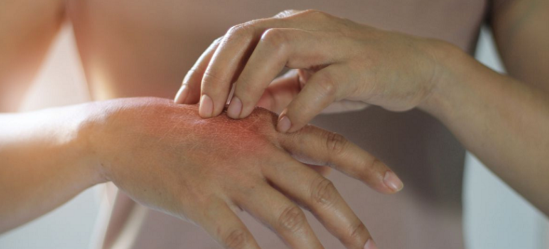 rheumatoid arthritis skin conditions