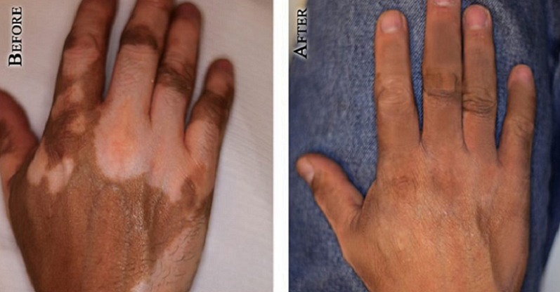 understanding vitiligo