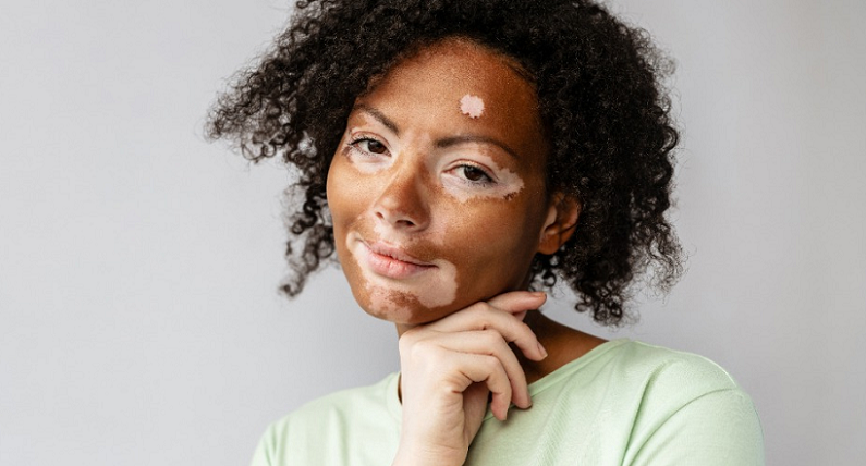 vitiligo psychological impact