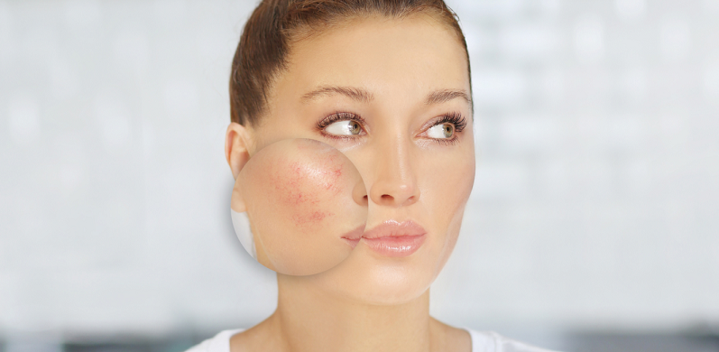 rosacea skincare donts